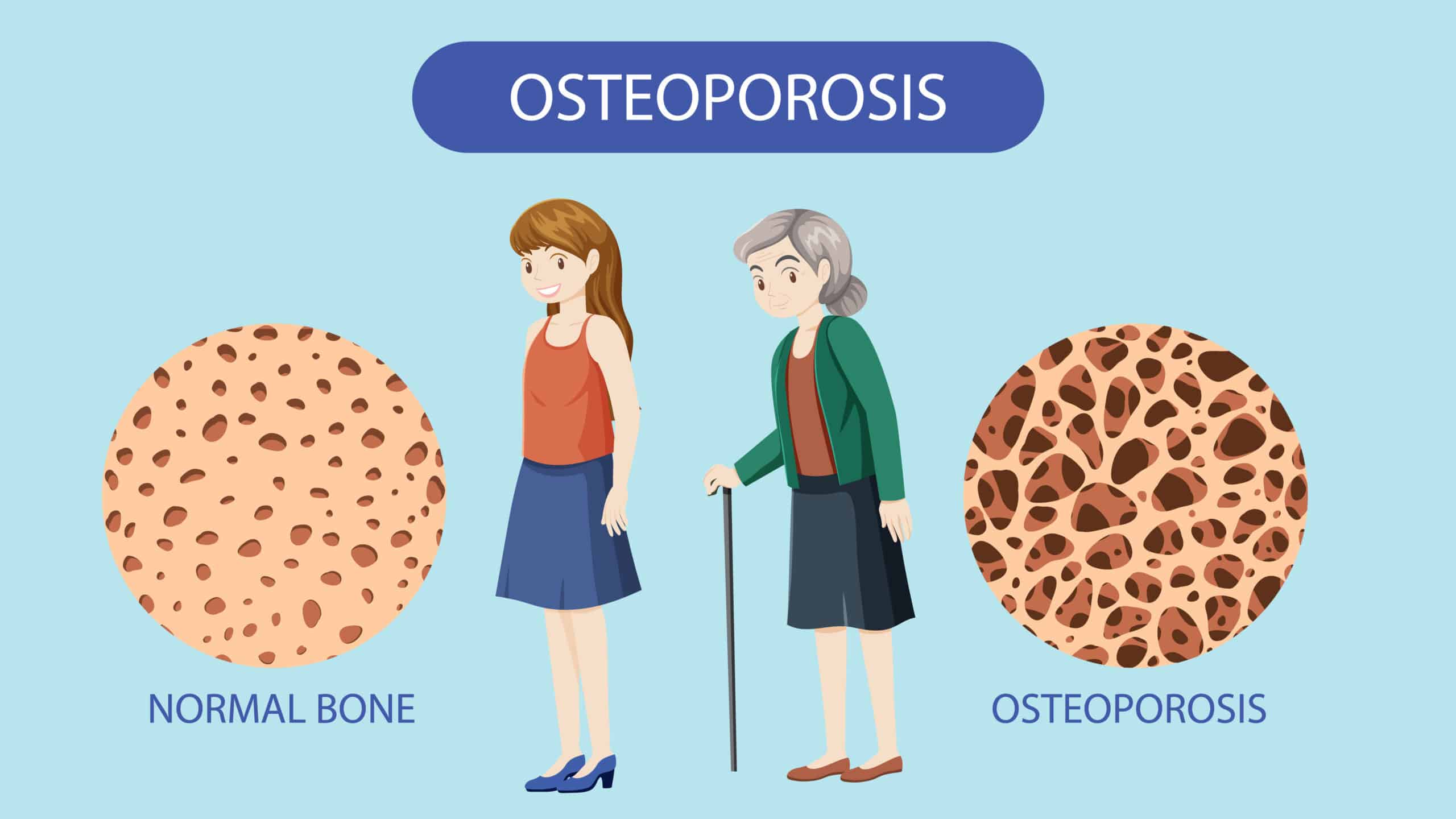 Medical Aid Schemes that Cover Osteoporosis