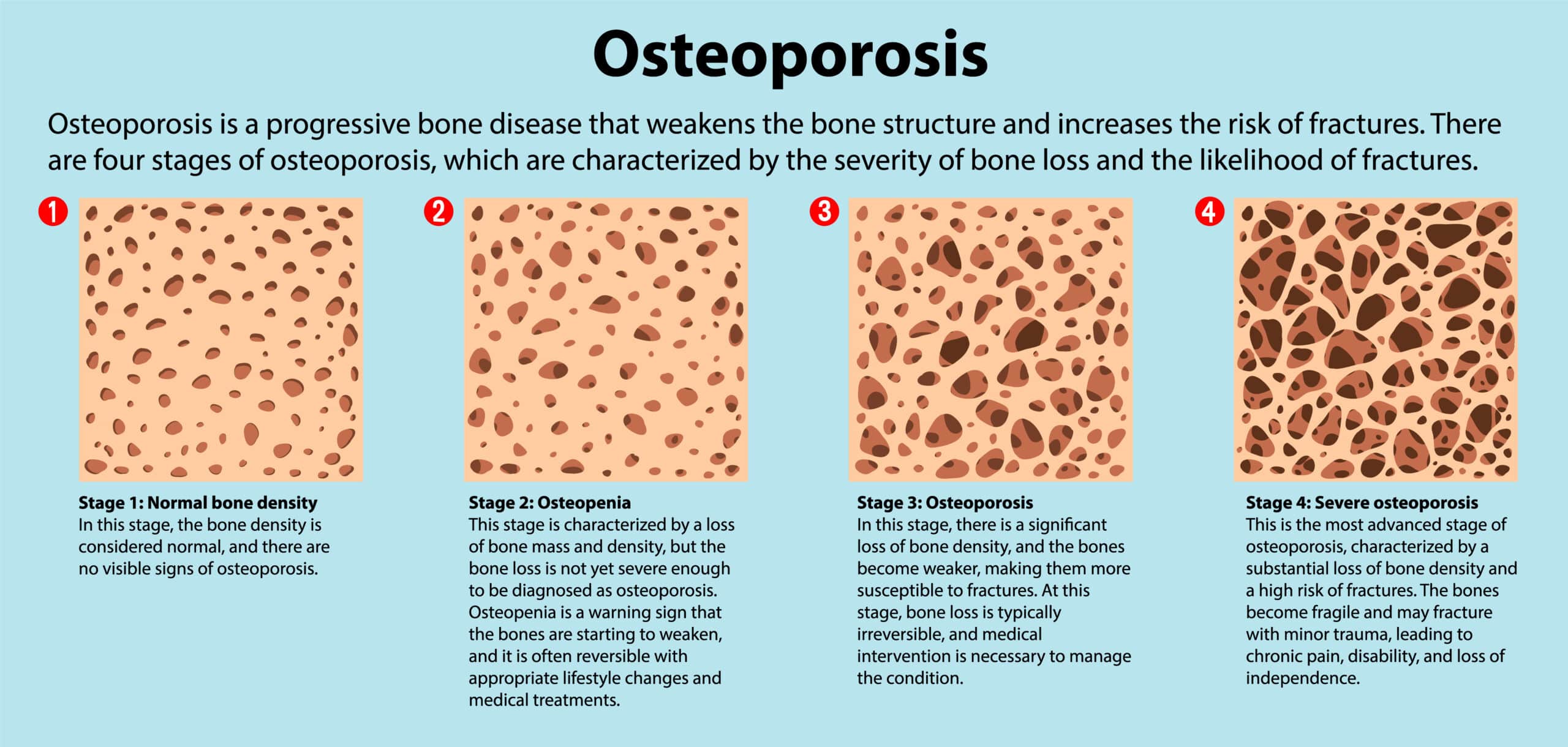 Medical Aid Schemes that Cover Osteoporosis - Symptoms