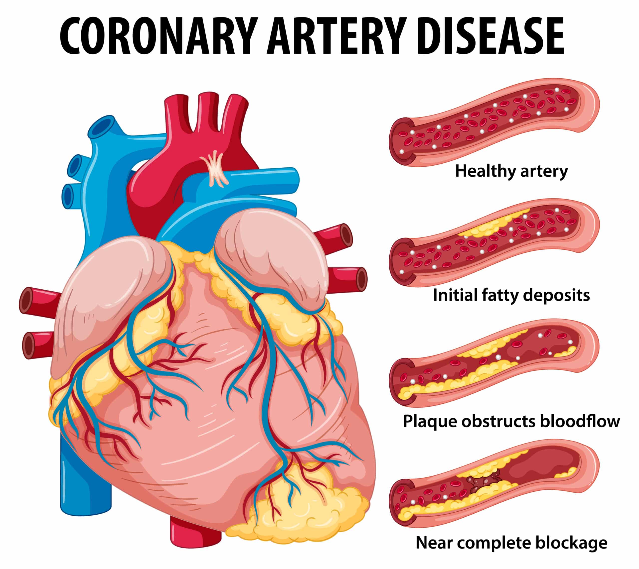 Medical Aid Schemes that Covering Coronary Artery Disease