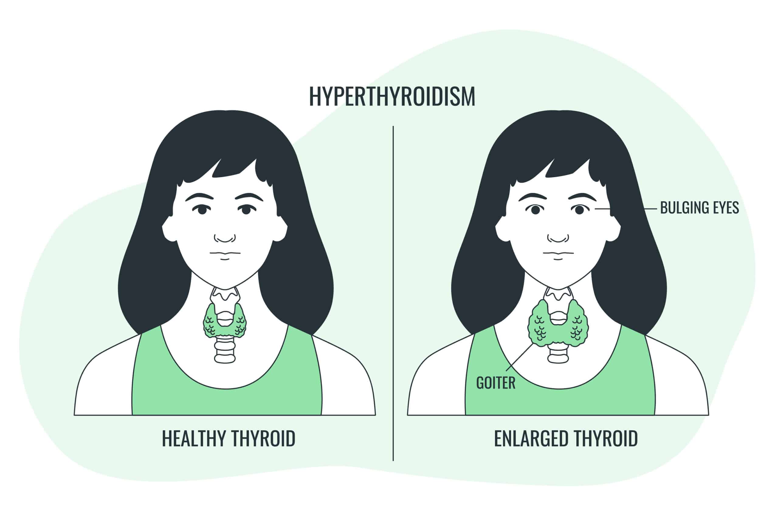 Medical Aid Schemes that Cover Hypothyroidism Treatment