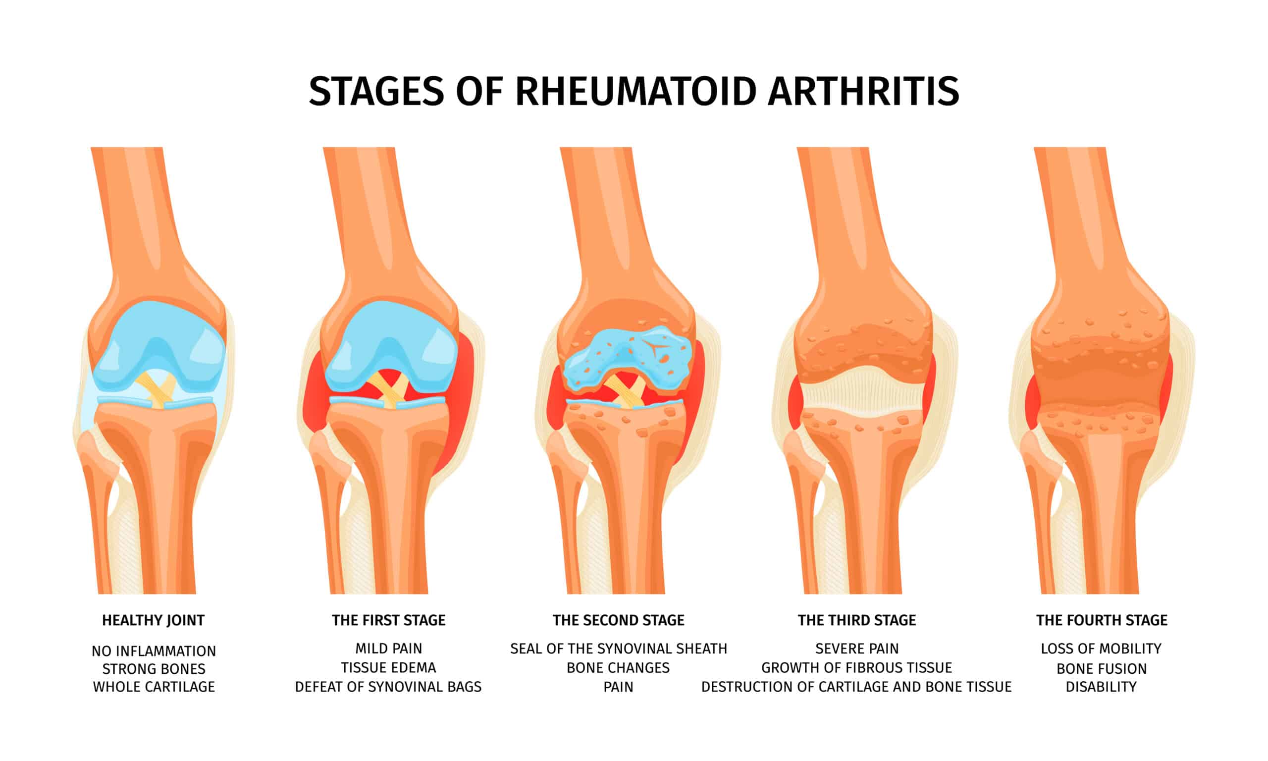 Medical Aid Schemes Covering Rheumatoid Arthritis