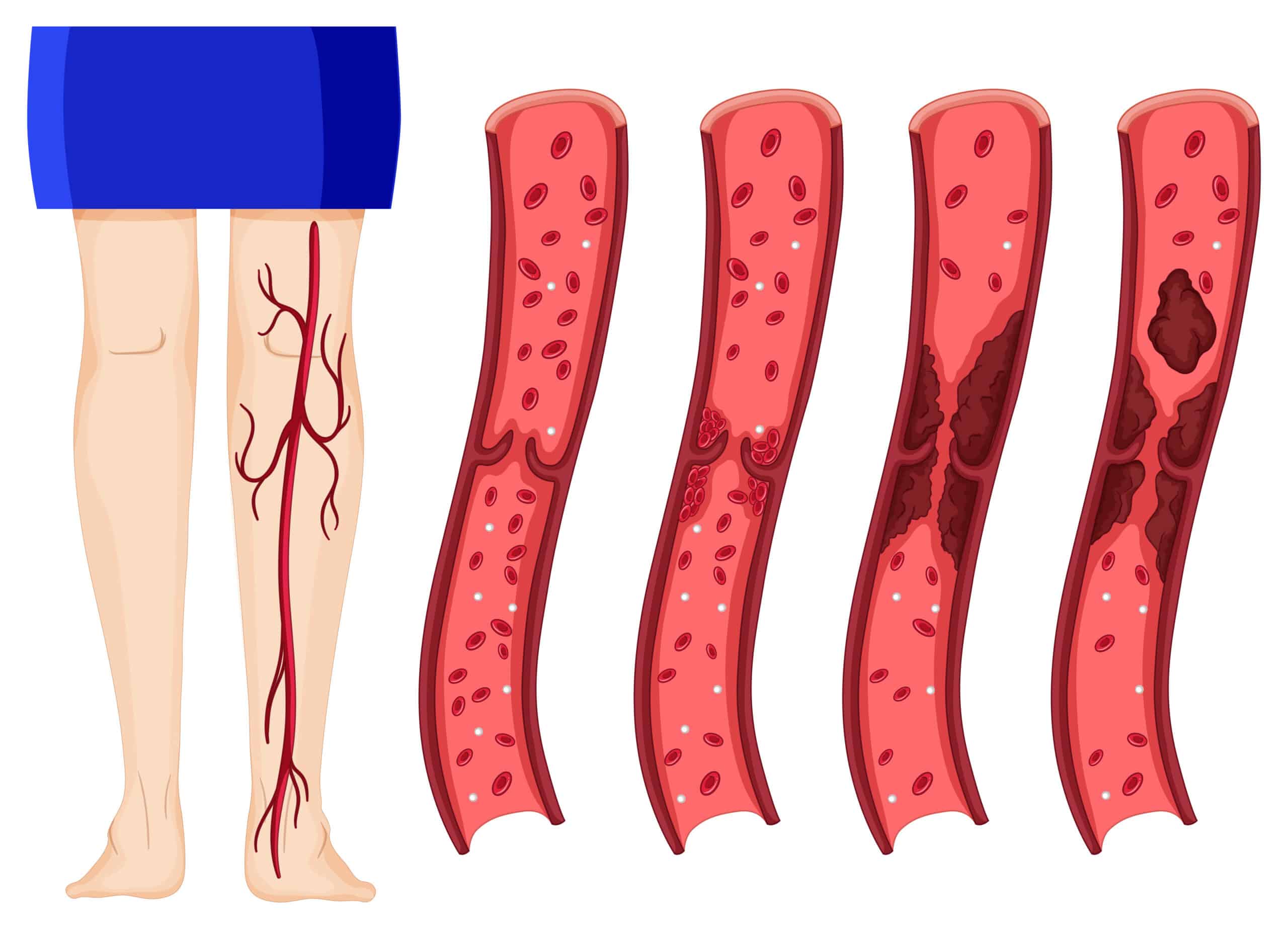 Medical Aid Schemes Covering Deep Vein Thrombosis